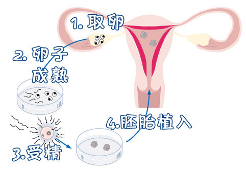 靠谱借卵代怀多少费用